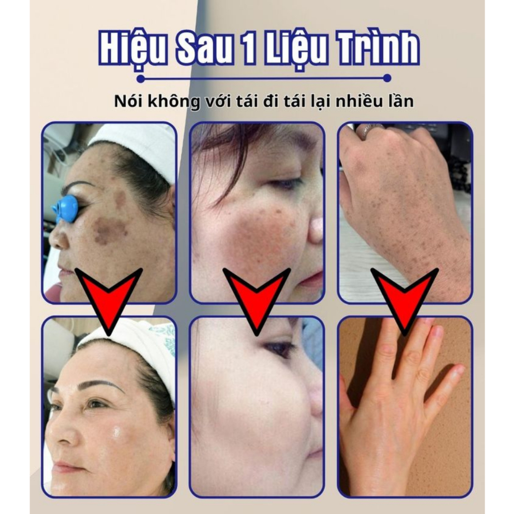 Kem Làm Mờ Nám Tàn Nhang DR.LI - Kem Dr.Li Tác Dụng Giúp Làm Mờ Những Vết Nám Tàn Nhang, Đồi Mồi Trên Da Và Da Mặt