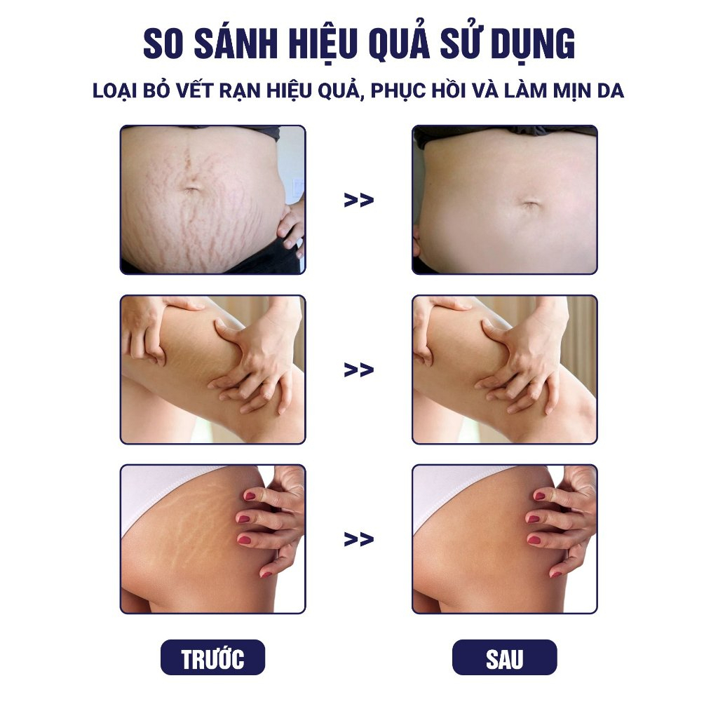 Kem Rạn Da Actiscar Hỗ Trợ Mờ Rạn Da, Mờ Sẹo Thâm, Đều Màu Sau Sinh