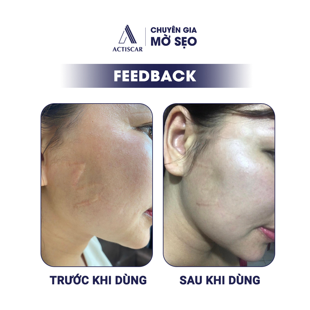 Combo Kem Sẹo Và Serum Sẹo Ngăn Ngừa Sẹo Lồi, Sẹo Phì Đại, Sẹo Thâm Actiscar