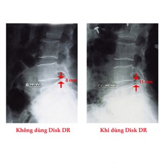 Đai Hơi Kéo Giãn Cột Sống Lưng Disk Dr WG-50
