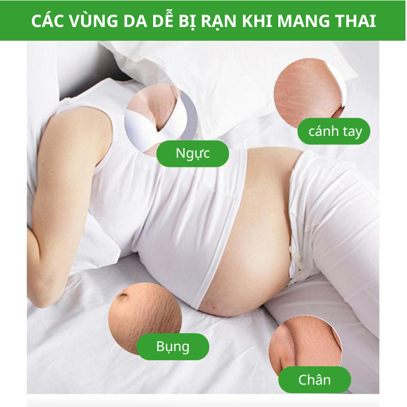 Kem Rạn Da - kem Dạn Da Sau Sinh Hỗ Trợ Giảm Sẹo Sau Sinh Làm Trắng Săn Chắc Da Sau Sinh Săn Chắc Mịn Màng SNMLPM