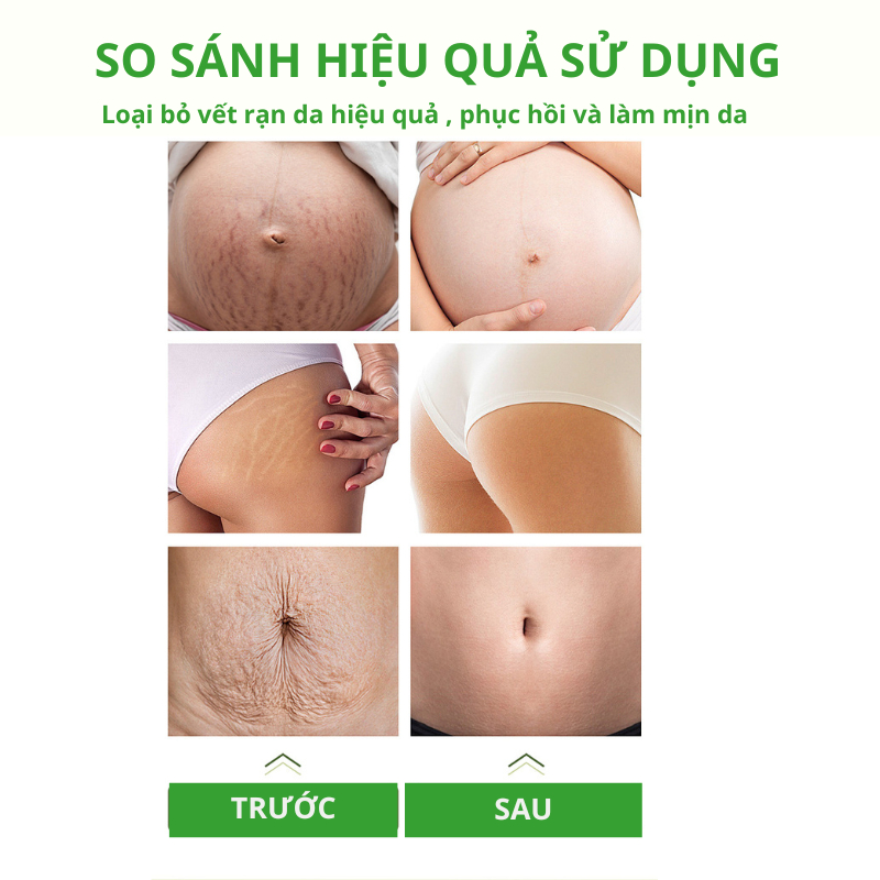 Kem Rạn Da - kem Dạn Da Sau Sinh Hỗ Trợ Giảm Sẹo Sau Sinh Làm Trắng Săn Chắc Da Sau Sinh Săn Chắc Mịn Màng SNMLPM