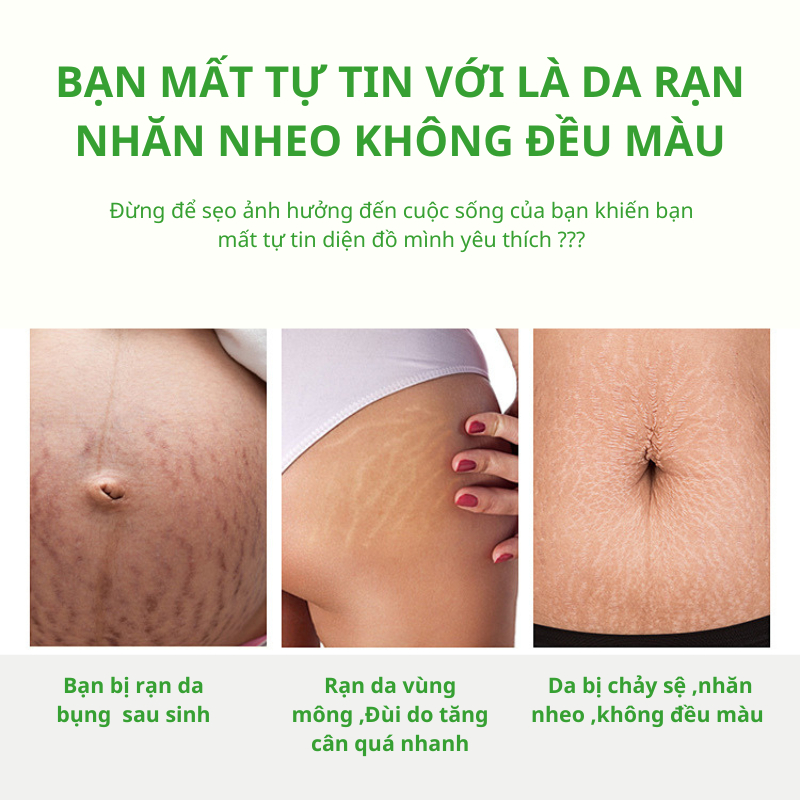 Kem Rạn Da - kem Dạn Da Sau Sinh Hỗ Trợ Giảm Sẹo Sau Sinh Làm Trắng Săn Chắc Da Sau Sinh Săn Chắc Mịn Màng SNMLPM