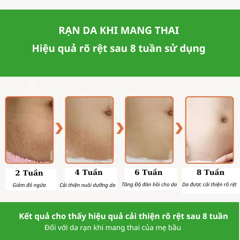 Kem Rạn Da - kem Dạn Da Sau Sinh Hỗ Trợ Giảm Sẹo Sau Sinh Làm Trắng Săn Chắc Da Sau Sinh Săn Chắc Mịn Màng SNMLPM