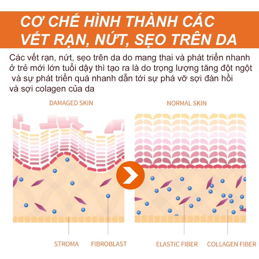 Kem Rạn Da An Toàn Cho Mẹ Bầu Trẻ Mới Lớn Hỗ Trợ Làm Trắng Giảm Sẹo Giúp Da Săn Chắc Mịn Màng EELHOE