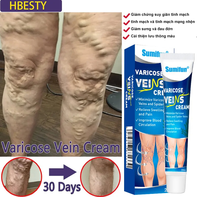 Kem chống giãn tĩnh mạch chăm sóc vùng chân cải thiện tuần hoàn máu làm dịu đau đớn Loại bỏ sưng mạch máu tay chân phồng