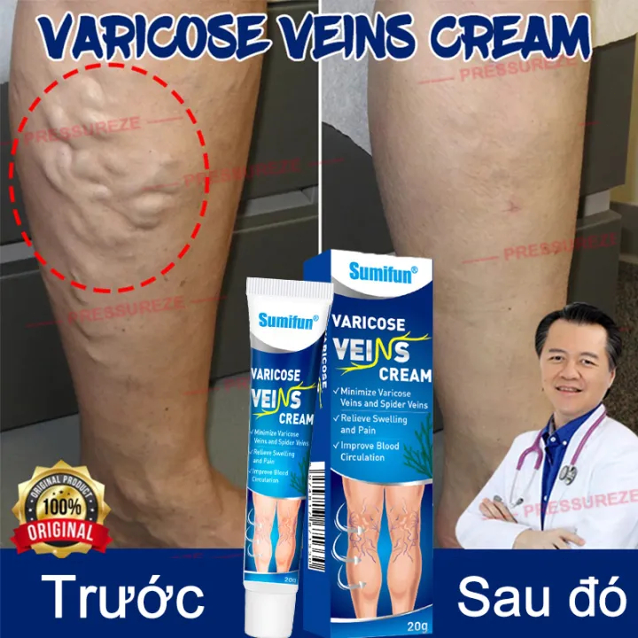 Kem chống giãn tĩnh mạch chăm sóc vùng chân cải thiện tuần hoàn máu làm dịu đau đớn Loại bỏ sưng mạch máu tay chân phồng