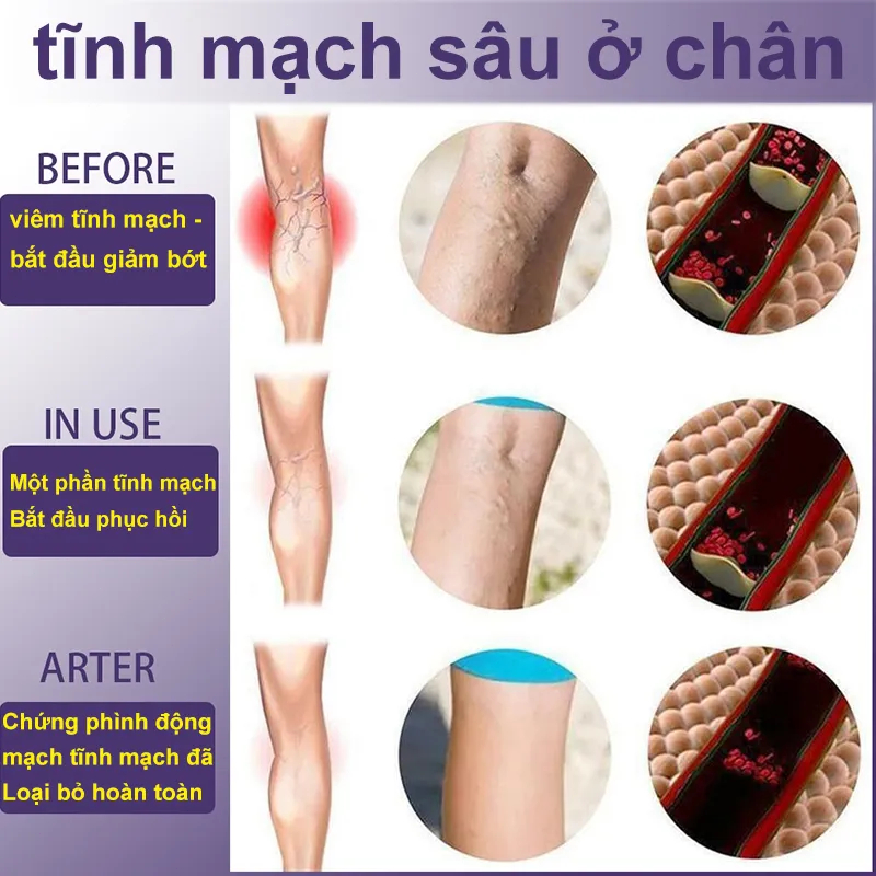 Kem chống giãn tĩnh mạch chăm sóc vùng chân cải thiện tuần hoàn máu làm dịu đau đớn Loại bỏ sưng mạch máu tay chân phồng