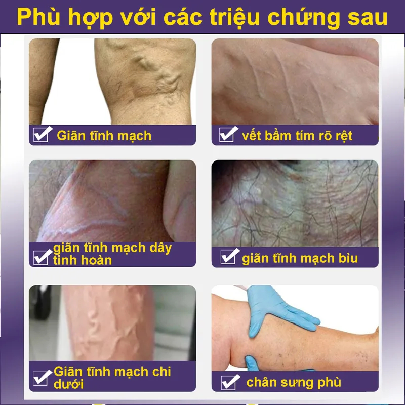 Kem chống giãn tĩnh mạch chăm sóc vùng chân cải thiện tuần hoàn máu làm dịu đau đớn Loại bỏ sưng mạch máu tay chân phồng