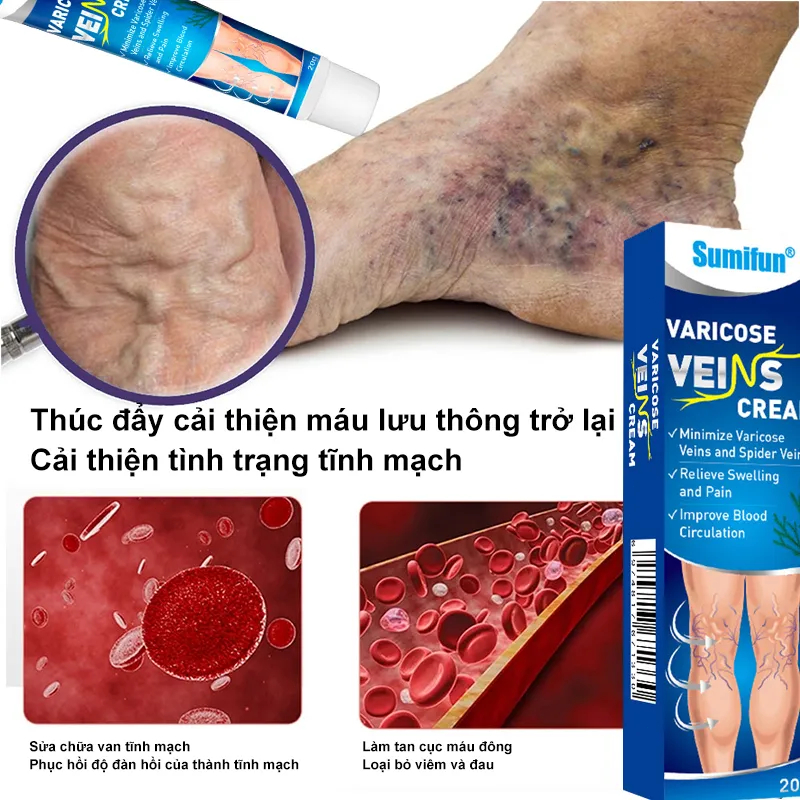 Kem chống giãn tĩnh mạch chăm sóc vùng chân cải thiện tuần hoàn máu làm dịu đau đớn Loại bỏ sưng mạch máu tay chân phồng