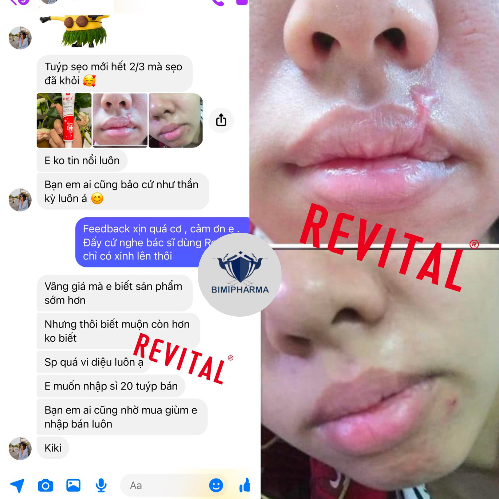 Kem mờ sẹo REVITAL - Kem REVITAL 30g mờ sẹo lồi, sẹo rỗ, sẹo lõm, sẹo lâu năm.. - LIMINA BEAUTY SHOP