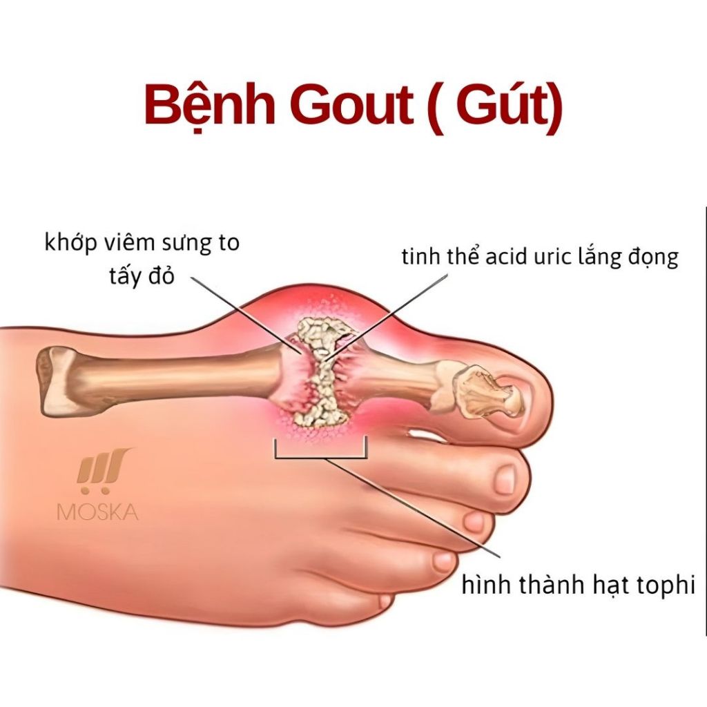 Viên Uống GUDCARE Hỗ Trợ Giảm Các Biểu Hiện, Giảm Đau Do Gud 60 viên| Moska Shop