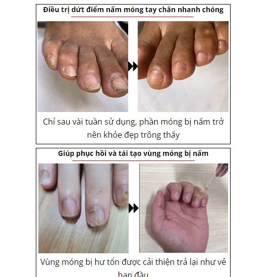 Tinh Chất Nấm Móng Kannedo - Serum Nấm Móng Nhật Bản Kannedo Giúp Cải Thiện Móng Hỏng, Phục Hồi Và Chăm Sóc Móng.