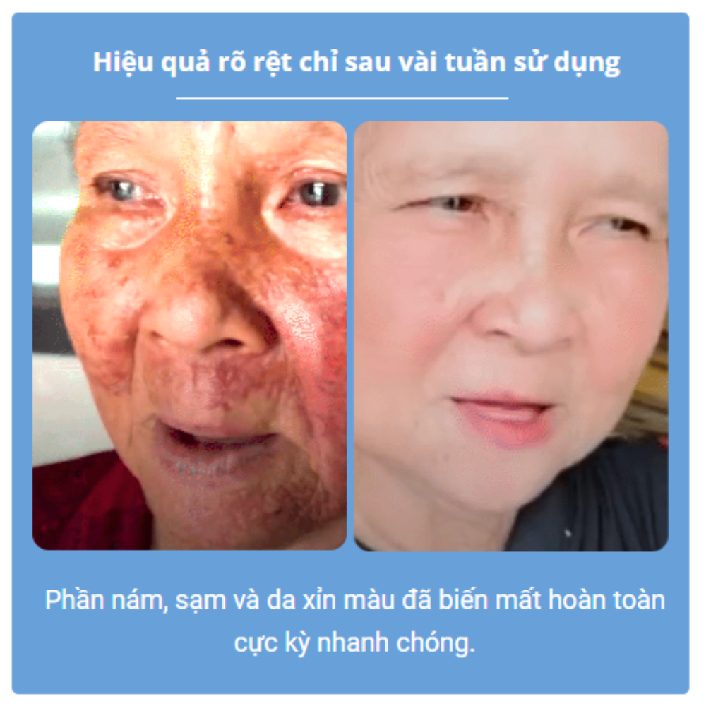 Tinh Chất Hút Tàn Nhang, Đồi Mồi HOUMAL - Serum HOUMAL Giảm Nám Mờ Tàn Nhang Đồi Mồi Giúp Làn Da Sáng Mịn