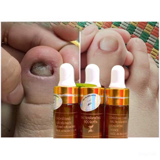 Serum đánh bay nấm móng, hư khoé, bọng móng, nước ăn tay chân gia truyền 4ml