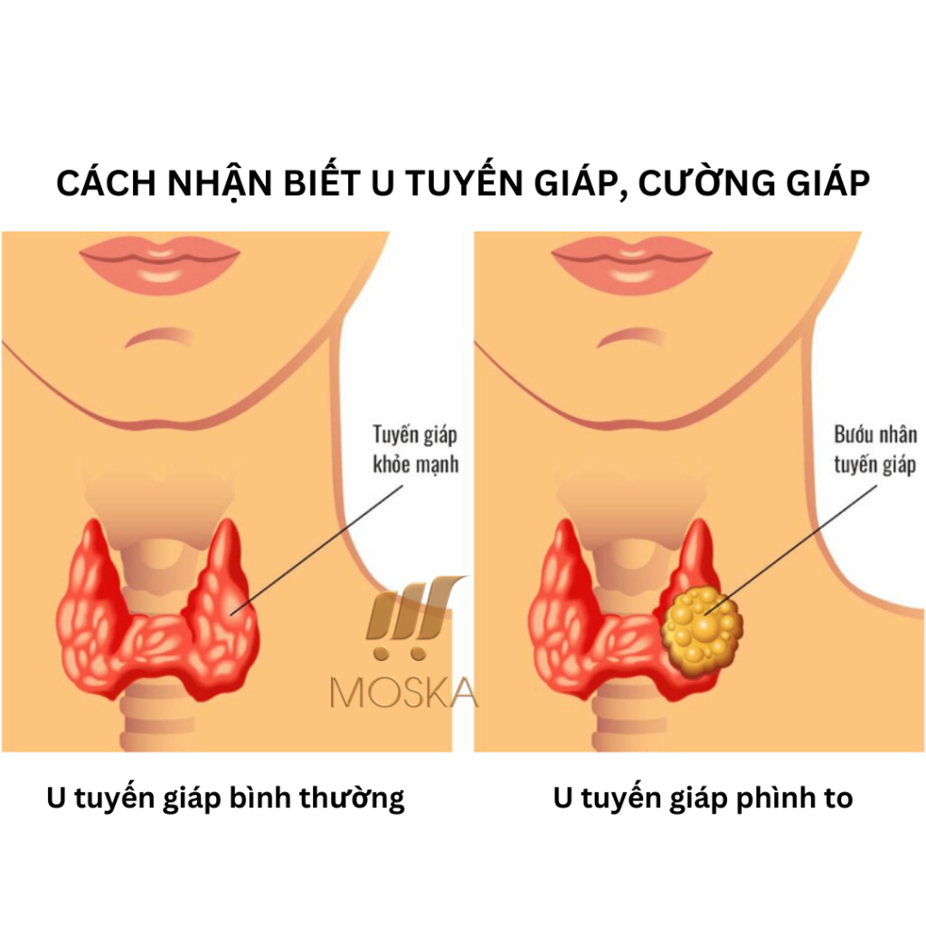 Kem Tan Rã Tuyến Giáp SENJOKO NHẬT BẢN 50GR, Kem Bôi Tuyến Giáp, Tan U Tuyến Giáp, Cường Giáp, BASEDOW, Phì Đại T.Giáp