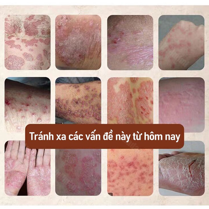 【Mua 2 tặng 1】Kem bôi nấm ngứa 30g hắc lào mề đay á sừng viêm da nấm da giải độc kem chống ngứa Kem bệnh chàm bệnh