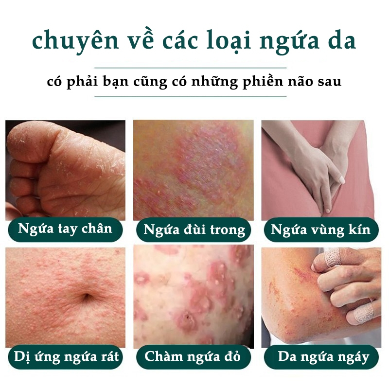 【Mua 2 tặng 1】Kem bôi nấm ngứa 30g hắc lào mề đay á sừng viêm da nấm da giải độc kem chống ngứa Kem bệnh chàm bệnh