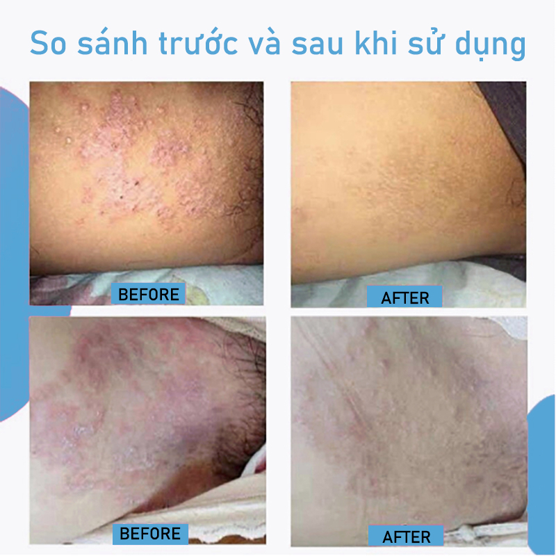 【Mua 2 tặng 1】Kem bôi nấm ngứa 30g hắc lào mề đay á sừng viêm da nấm da giải độc kem chống ngứa Kem bệnh chàm bệnh