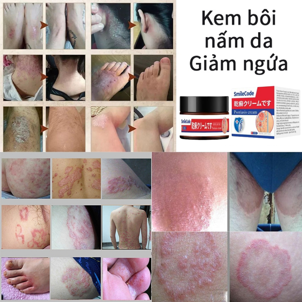 【Mua 2 tặng 1】Kem bôi nấm ngứa 30g hắc lào mề đay á sừng viêm da nấm da giải độc kem chống ngứa Kem bệnh chàm bệnh