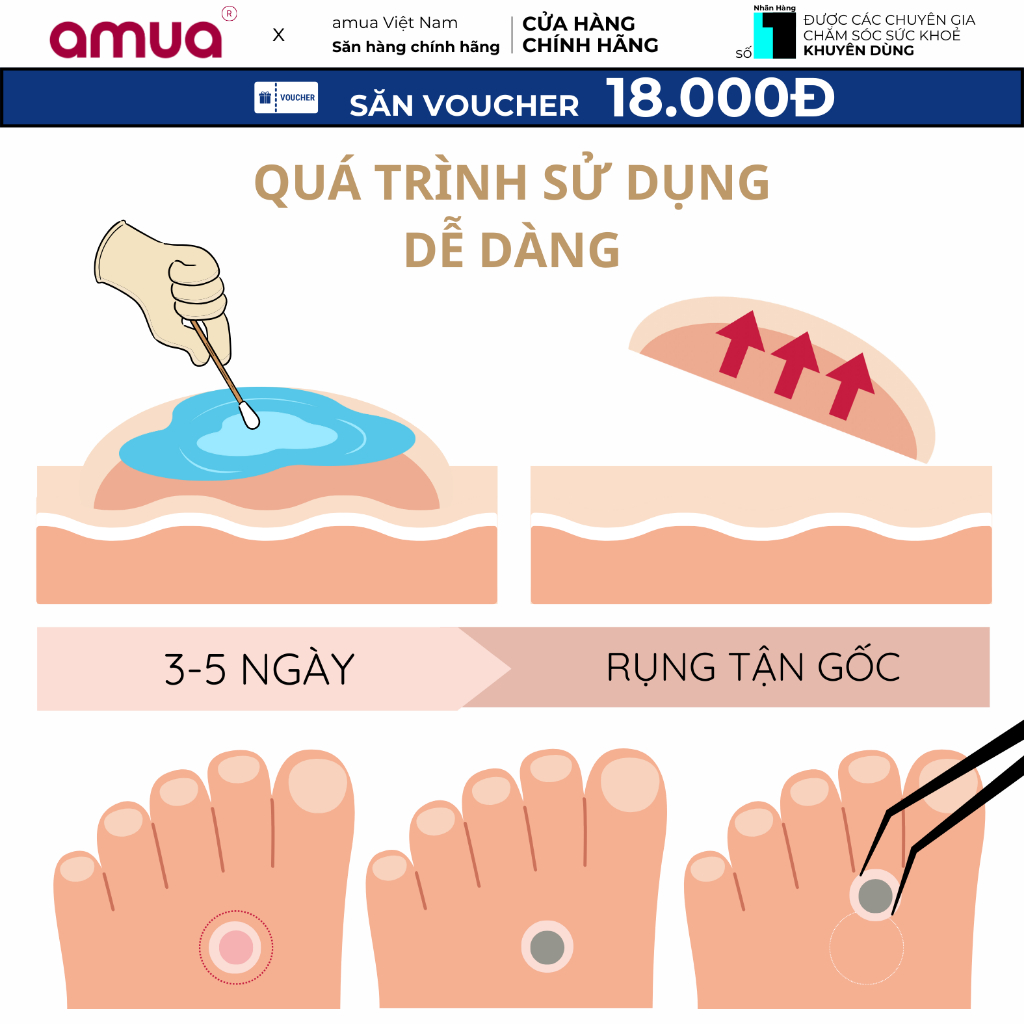 Podophyllin 25% Vidhyasom Thái Lan 15ml - Dung dịch Podophyllin 25%
