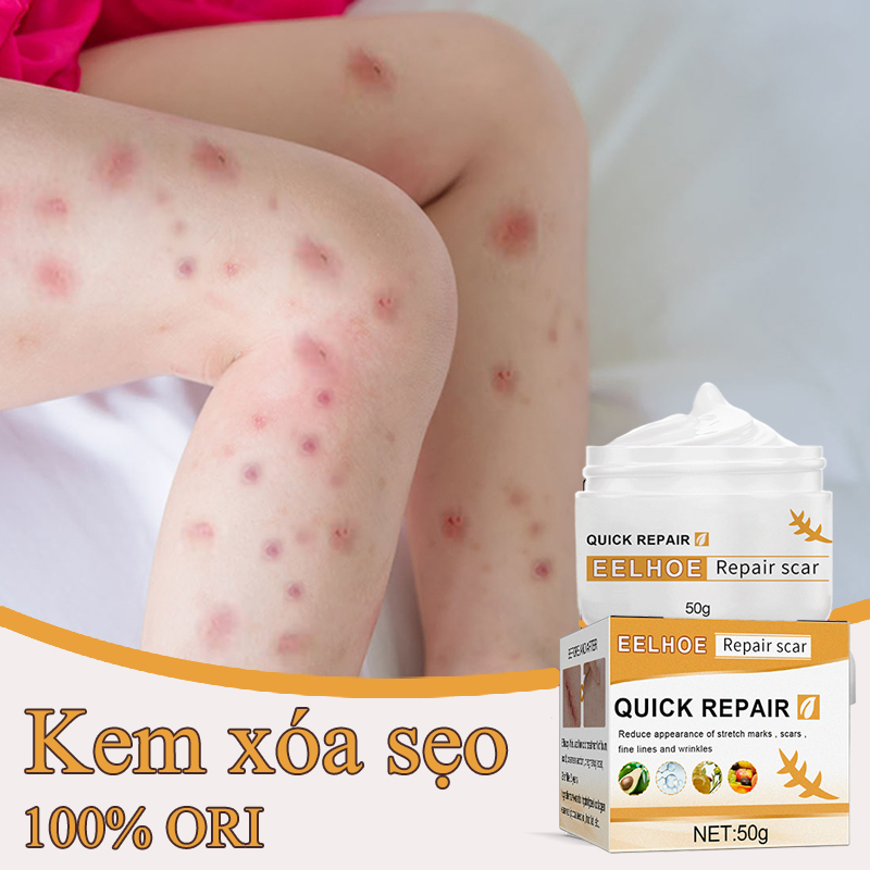 Kem Xoá Mờ Sẹo Lồi Lõm Bỏng Bôi Thủy Đậu Sẹo Lõm Sẹo Rỗ Sẹo Thâm Lâu Năm sẹo thâm mun sẹo lõm lâu năm nhanh chóng 50g