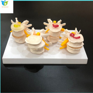 Bộ 4 mô hình mô tả tình trạng bệnh lý cột sống thắt lưng và thoát vị đĩa đệm
