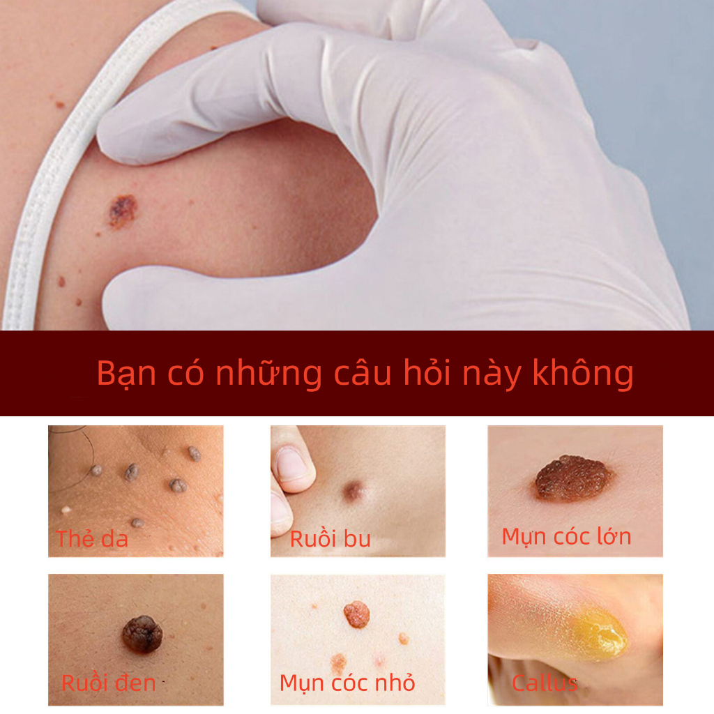 Kem Tẩy Nốt Ruồi Jaysuing - Giải Pháp Loại Bỏ Mụn Cóc, Mụn Cơm, Mụn Thịt Tại Nhà Không Để Lại Sẹo