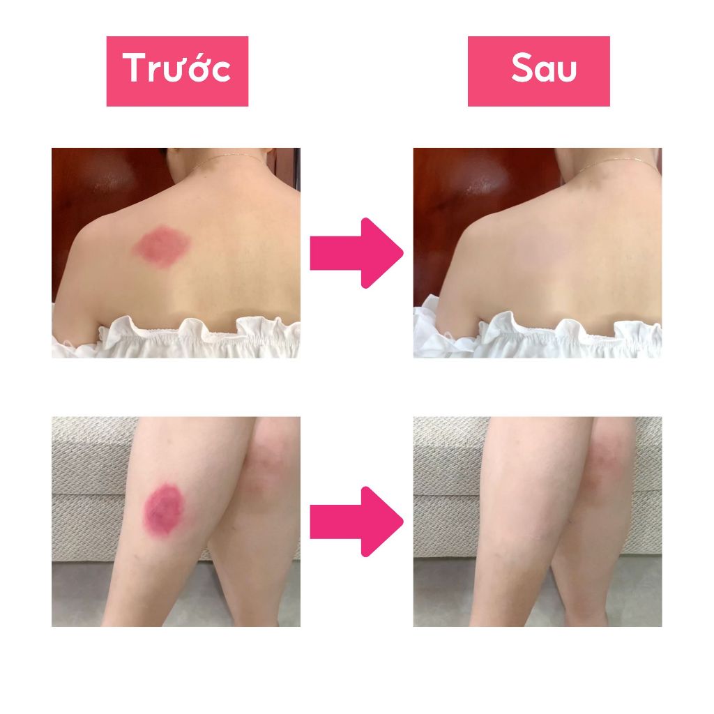 Miếng dán che sẹo che khuyết điểm Nhật Bản Sakura tiệp màu da, nhiều size nhiều màu | BigBuy360 - bigbuy360.vn