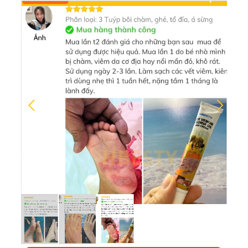 Kem Hbesty Bôi Tổ Đỉa, Mụn Nước - Kem Hbesty Giúp Giảm Ngứa, Sưng, Tổ Đỉa, Mụn Nước và Dưỡng Da Khỏe Mạnh