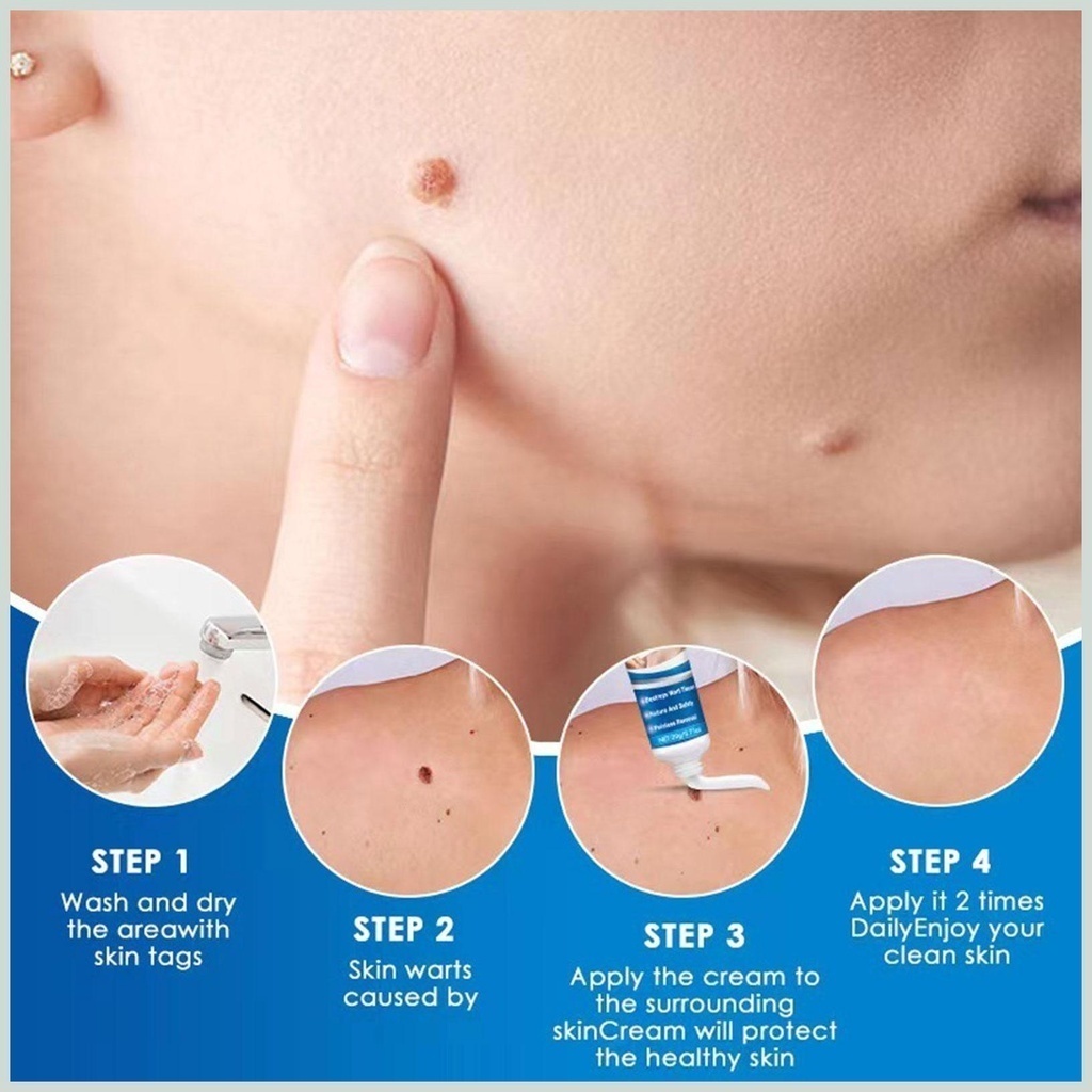 Kem Mụn Thịt Dư, Mụn Cóc Hbesty Wart Remover Cream - Kem Bật Gốc Cồi Mụn, Rụng Mụn Thịt Dư, Không Đau Ngứa