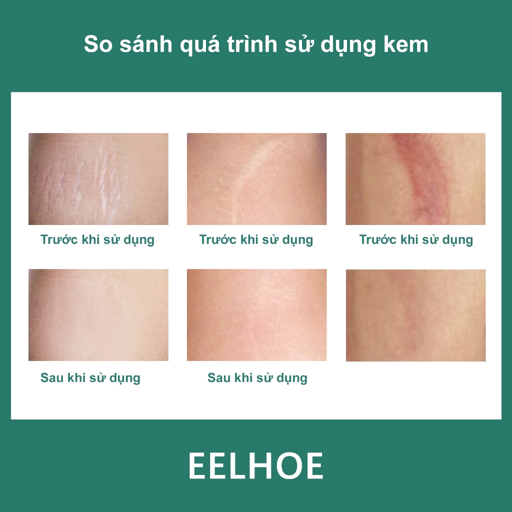 Kem Sẹo EELHOE Chính Hãng Làm Mịn Da và Phục Hồi Sẹo Phẫu Thuật Xóa Mờ Sẹo Phục Hồi Làn Da Bị Thương