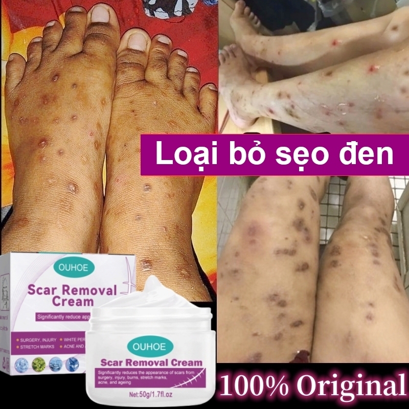 Kem LàM Mờ SẹO ThâM thâm sẹo do bị thương sẹo bỏng sẹo phẫu thuật sửa chữa tất cả các rạn da loại bỏ vết sẹo muỗi đốt
