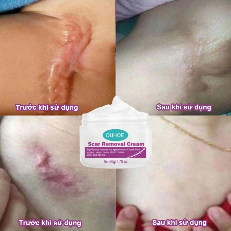 Kem LàM Mờ SẹO ThâM thâm sẹo do bị thương sẹo bỏng sẹo phẫu thuật sửa chữa tất cả các rạn da loại bỏ vết sẹo muỗi đốt