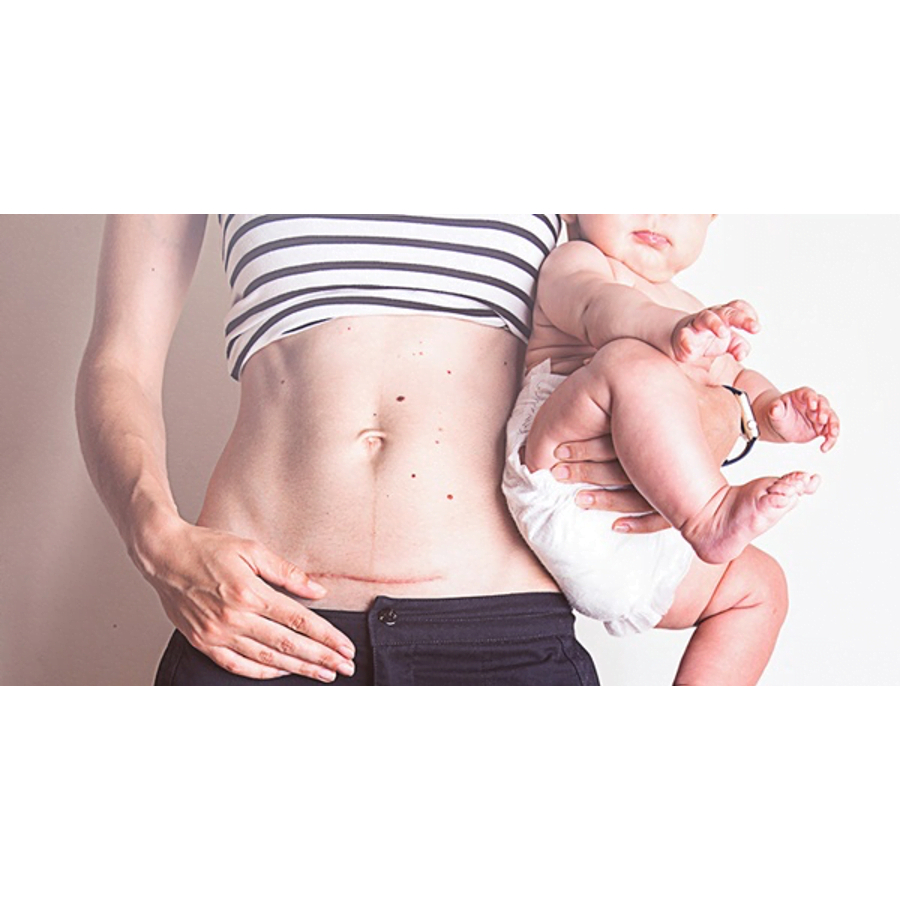 Kem Làm Mờ Sẹo Vết Mổ Sau Sinh Hiệu Quả Từ 2 Tuần An Toàn Cho Mẹ Và Bé Provamed Scar Silicone