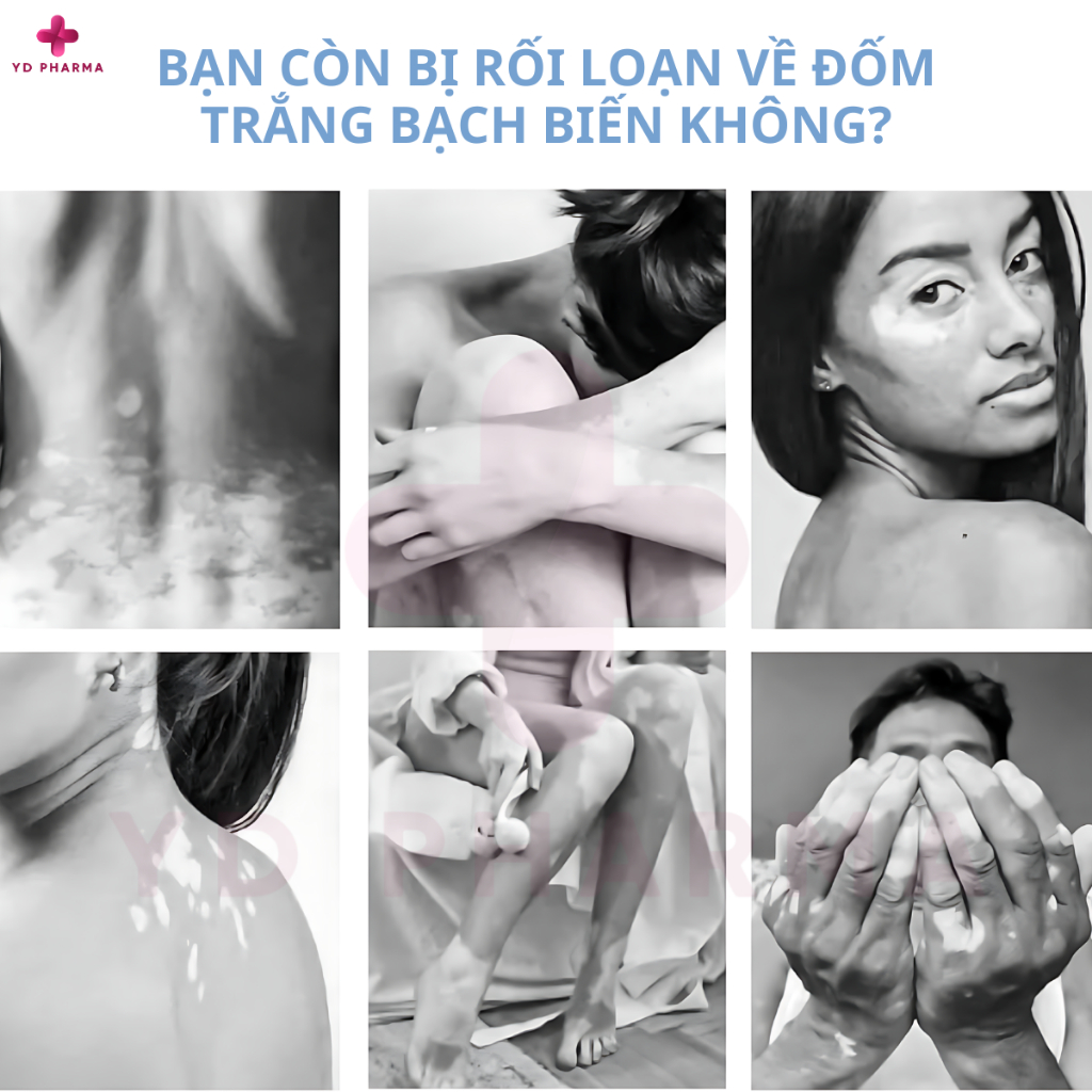 Kem Bôi Tan Bạch Biến Southmoon Mỹ, Lang Beng, Đốm Trắng, Giảm Bong Tróc, Điều Hòa Sắc Tố Giúp Da Đều Màu 35G| YD Pharma