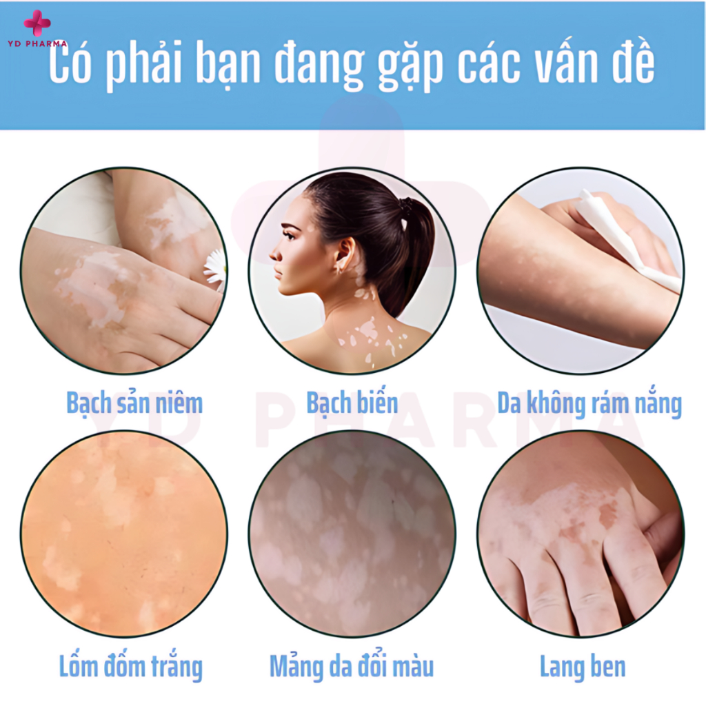Kem Bôi Tan Bạch Biến Southmoon Mỹ, Lang Beng, Đốm Trắng, Giảm Bong Tróc, Điều Hòa Sắc Tố Giúp Da Đều Màu 35G| YD Pharma
