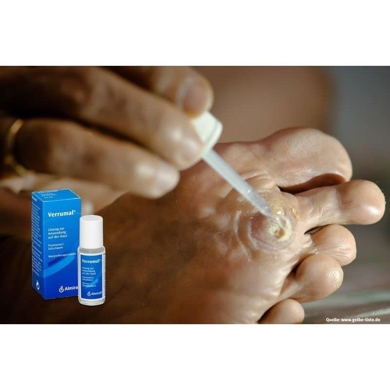 Verrumal solution bôi sùi mào gà lưỡi và vị trí đặc biệt, hết sạch sùi mào gà chính hãng Đức (Che tên SP)
