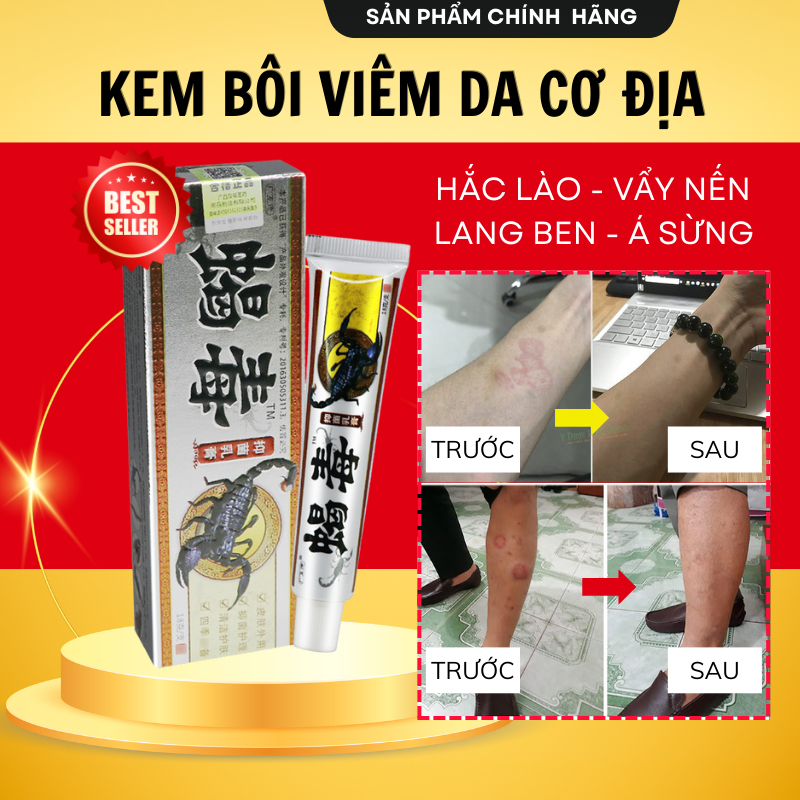 Kem Bôi Viêm Da Cơ Địa Nấm Ngứa BỌ CẠP Hắc Lào, Tổ Đỉa, Vẩy Nến, Á Sừng, Lang Ben Hiệu Quả