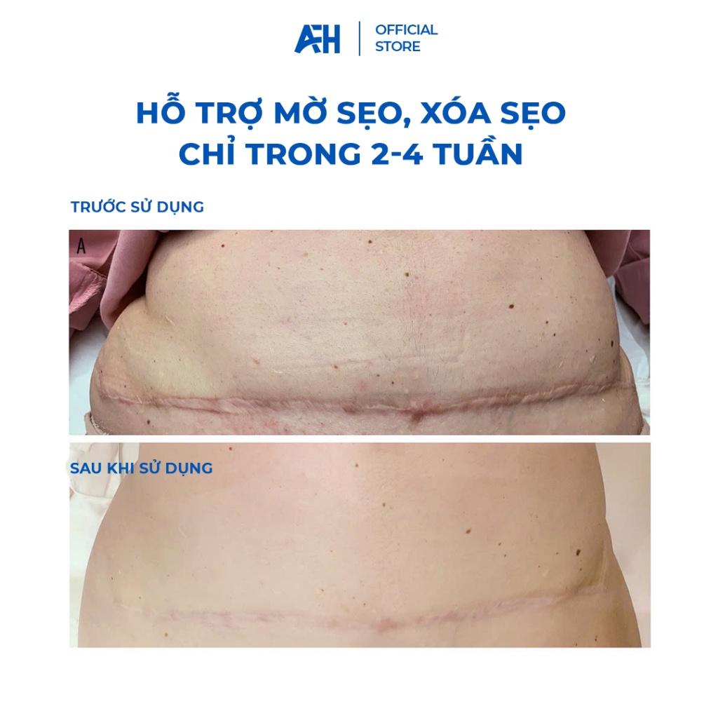 Kem Làm Mờ Sẹo Vết Mổ Sau Sinh Hiệu Quả Từ 2 Tuần An Toàn Cho Mẹ Và Bé Provamed Scar Silicone