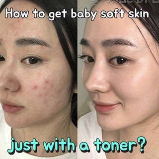 Bộ Dưỡng Da Mụn Some By Mi Aha-Bha-Pha 30 Days Miracle
