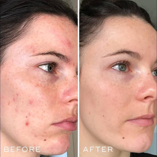 Serum phục hồi cấp ẩm B5 Medik8