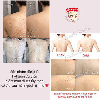 Xịt Mụn Lưng Senakyua Hiệu Quả Sạch Mụn Thâm Chính Hãng Nhật Bản