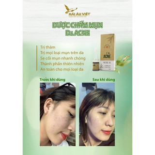 Combo 5 serum mụn napoli