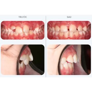 [Y Tế Bạch Mai] Dụng Cụ Niềng Răng Trainer T4K Hàng ÚC