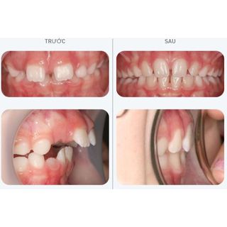 [Y Tế Bạch Mai] Dụng Cụ Niềng Răng Trainer T4K Hàng ÚC