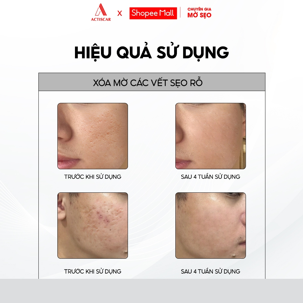 Kem Xoá Mờ Sẹo Actiscar 20g Hỗ Trợ Xóa Mờ Sẹo Lồi, Lõm, Bỏng Bô, Thủy Đậu