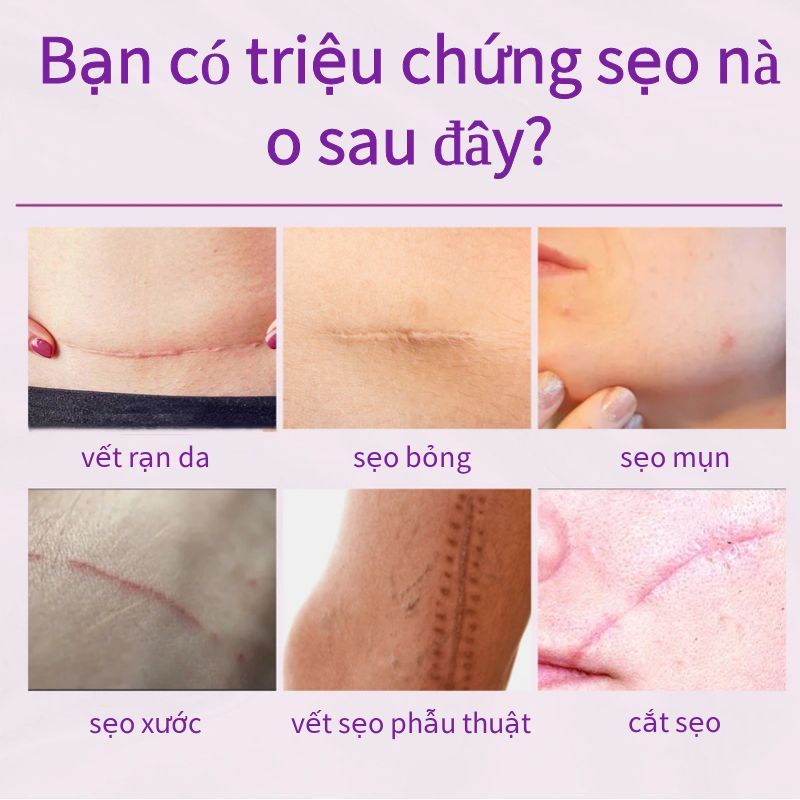 Kem xóa sẹo, kem xóa sẹo, kem giảm sẹo lồi, kem làm mờ sẹo phẫu thuật, kem làm mờ sẹo thâm, kem giảm sẹo