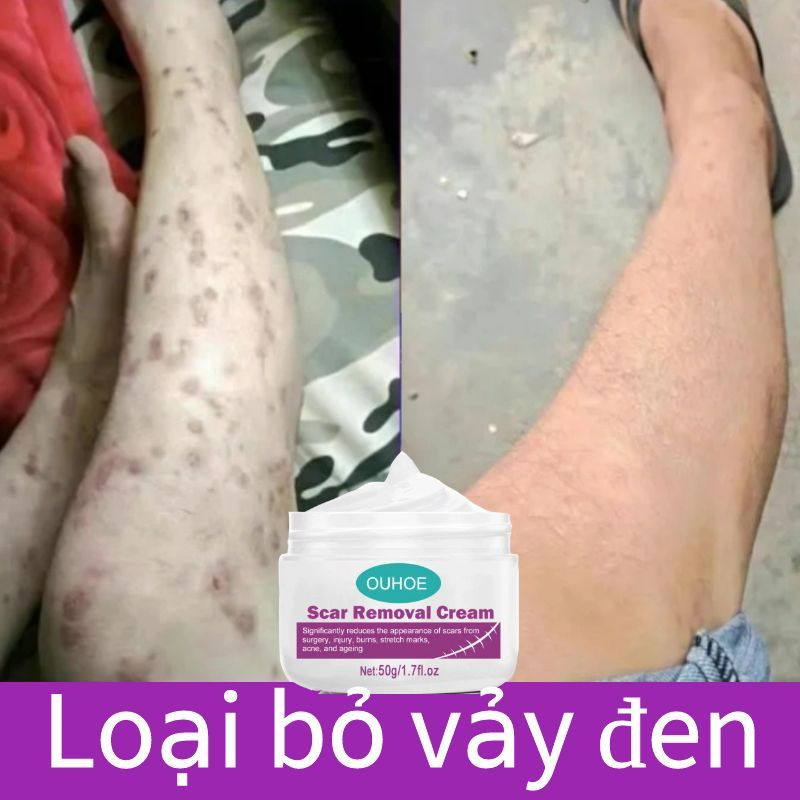 Kem xóa sẹo, kem xóa sẹo, kem giảm sẹo lồi, kem làm mờ sẹo phẫu thuật, kem làm mờ sẹo thâm, kem giảm sẹo