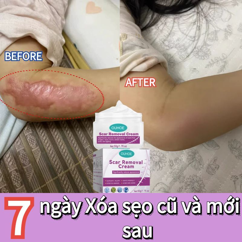 Kem xóa sẹo, kem xóa sẹo, kem giảm sẹo lồi, kem làm mờ sẹo phẫu thuật, kem làm mờ sẹo thâm, kem giảm sẹo